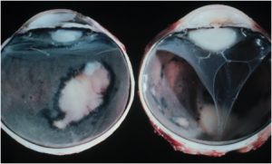 Toxoplasmosis